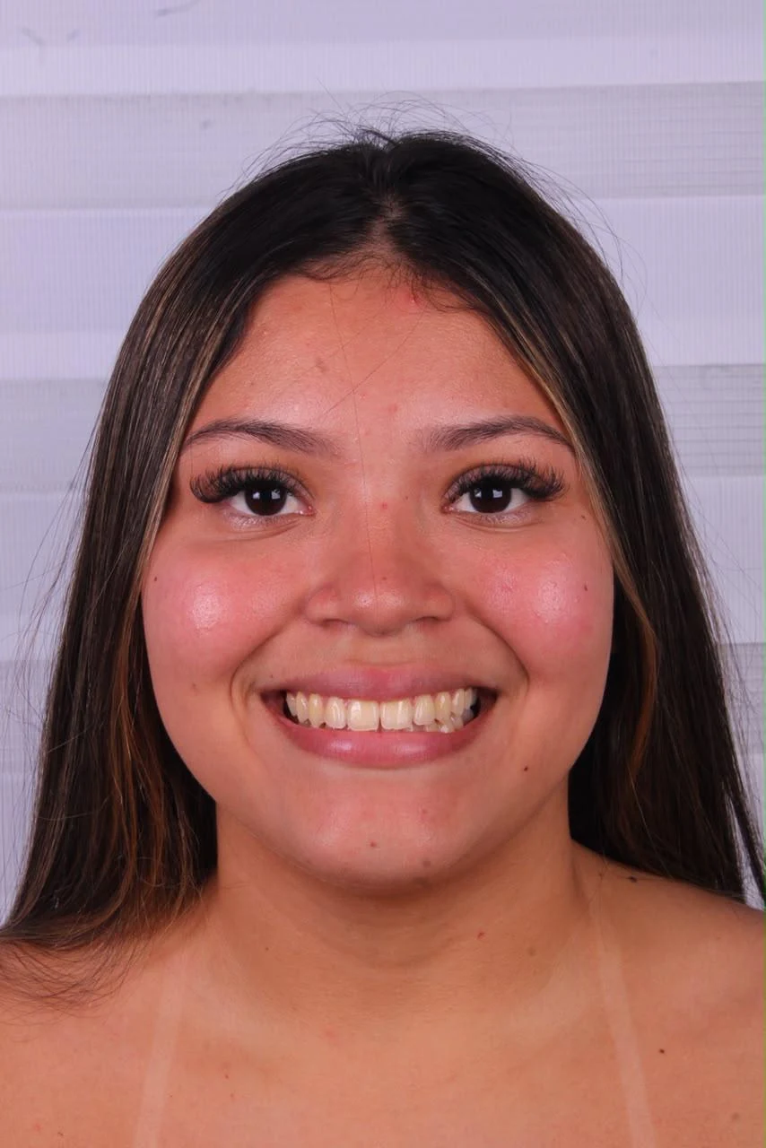 Antes do tratamento de Facetas em Resina